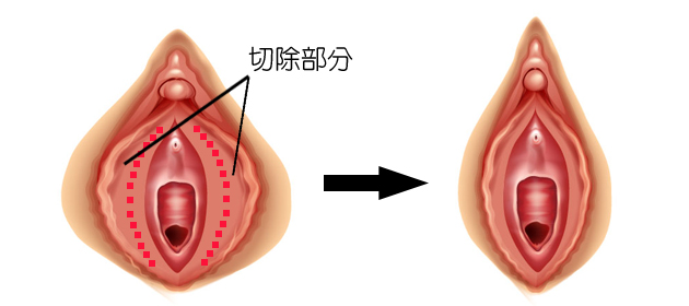 小 陰唇 縮小 手術