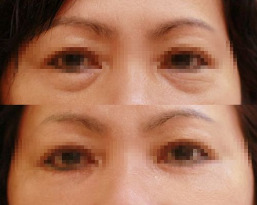 老眼袋說掰掰~眼袋手術大成功