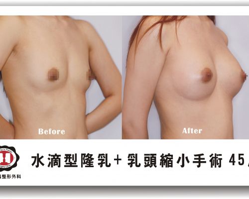 《果凍隆乳+縮乳頭手術》讓我找回女人的自信